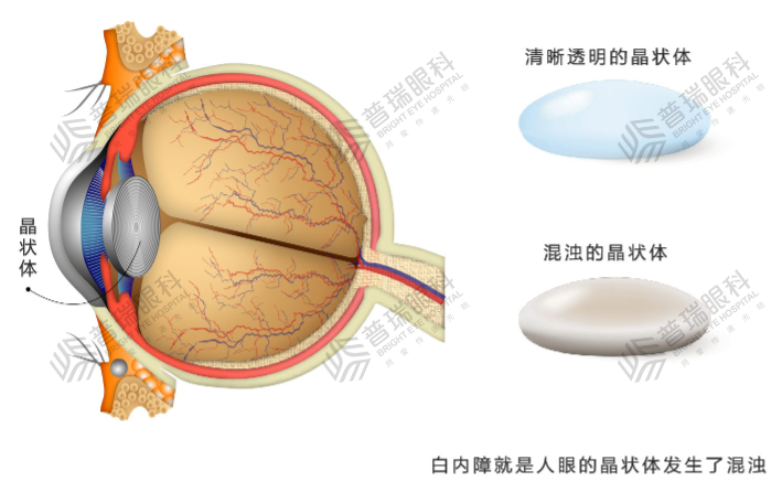 华德眼科：年纪大看不清，是因为老花眼、白内障还是眼底病？