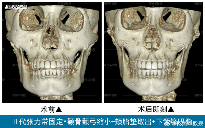 联合丽格第一医院何照华院长：颧骨内推后脸为何没变小？