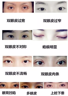 双眼皮做失败了？田永成医美告诉你如何修复