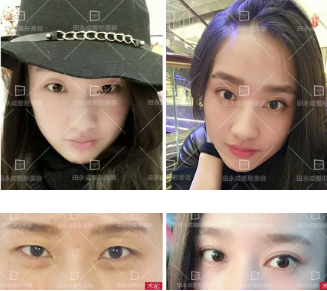 双眼皮做失败了？田永成医美告诉你如何修复