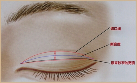 田永成整形美容医院：让双眼皮肉条消失，可以这么做