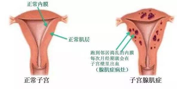 今日妇产：能保子宫，绝不切除！ ——北京五洲妇儿医院妇科首席专家李蔚范