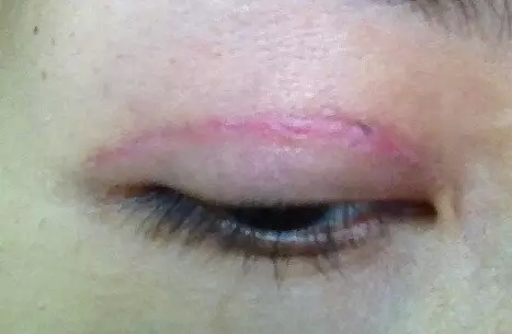 疤痕体质可以做双眼皮吗,整形专家田永成告诉你!
