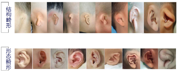 丽格慈善基金会携手耳再造专家安波博士团队，公益救助小耳畸形患儿