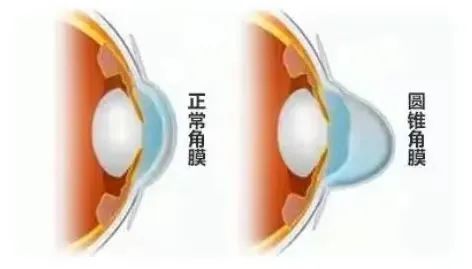 【华德眼科】角膜生物力学风险排查，「黄金CP」为近视手术保驾护航