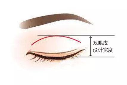 联合丽格第一医院吴焱秋教授：双眼皮做多宽才自然？
