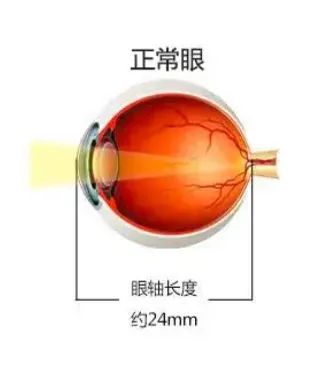 暑期摘镜总动员|做近视手术查眼底却发现有“洞”，还能做近视手术吗？