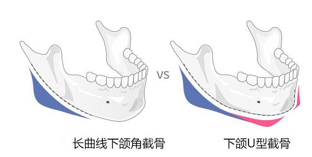 联合丽格第一医院何照华院长：下颌角手术虽香，但选对方法很重要！