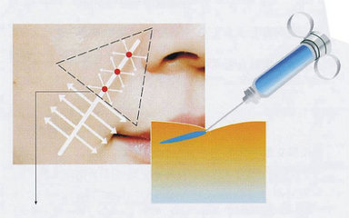 煤医整形罗羽博士:年纪轻轻显老,还不关注一下你的鼻唇沟?